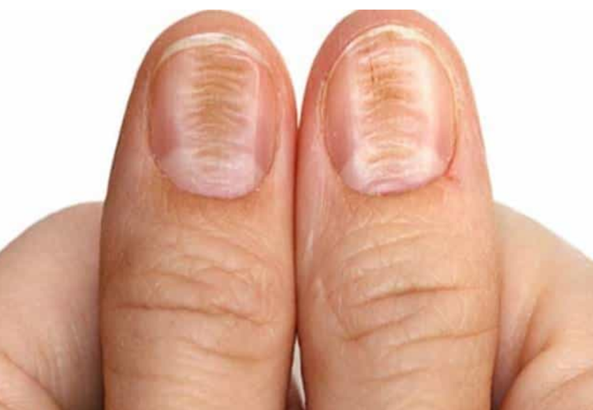 Волнистые ногти