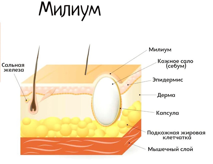 Причины появления белых угрей