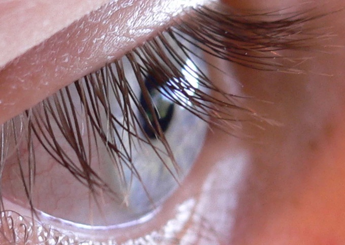 Как эффективно устранить мешочки вокруг глаз