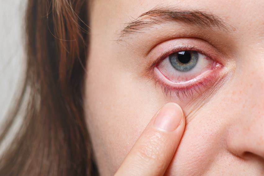 Чешутся глаза после наращивания ресниц: причины и лечение