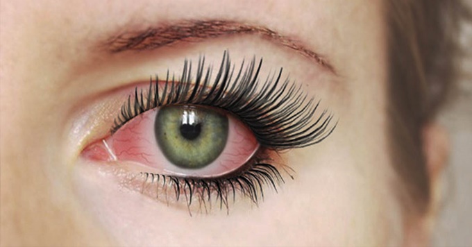 Химический ожог роговицы глаза: признаки и лечение