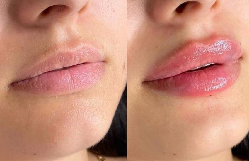 Ассиметрия губ: основные причины и способы коррекции в косметологической клинике Institute Clinic