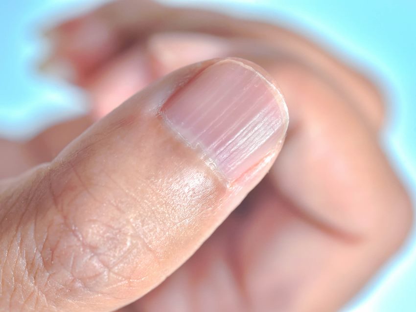 Примеры ребристых ногтей на большом пальце и их значения