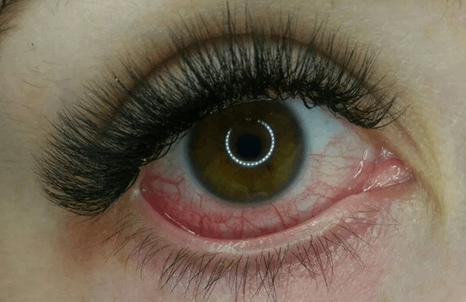 Красные глаза после наращивания ресниц: от чего и как лечить